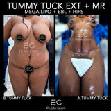 Abdominoplasty/Tummy Tuck (deposit only)