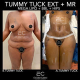 Abdominoplasty/Tummy Tuck (deposit only)