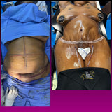 Abdominoplasty/Tummy Tuck (deposit only)