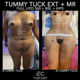 Abdominoplasty/Tummy Tuck (deposit only)