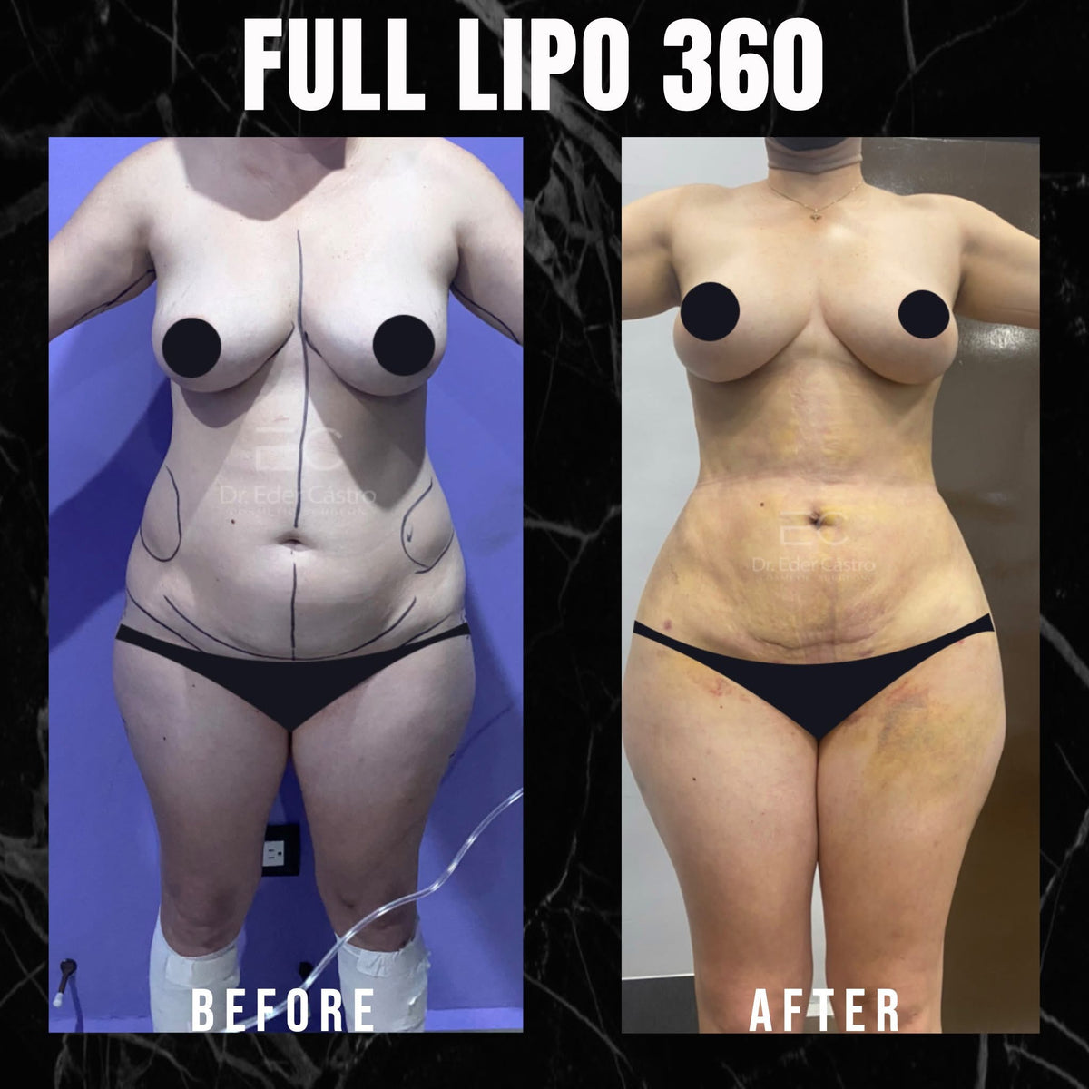 Liposuction (Lipo 360)  KWU's Health & Wellness Spa LLC