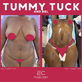 Abdominoplasty/Tummy Tuck (deposit only)