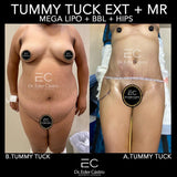 Abdominoplasty/Tummy Tuck (deposit only)