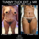 Abdominoplasty/Tummy Tuck (deposit only)
