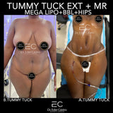 Abdominoplasty/Tummy Tuck (deposit only)