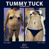 Abdominoplasty/Tummy Tuck (deposit only)
