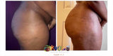 Butt Lift Therapy (8) sessions