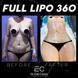 Liposuction (Lipo 360)