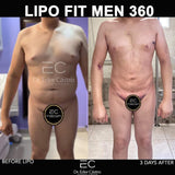 Liposuction (Lipo 360)