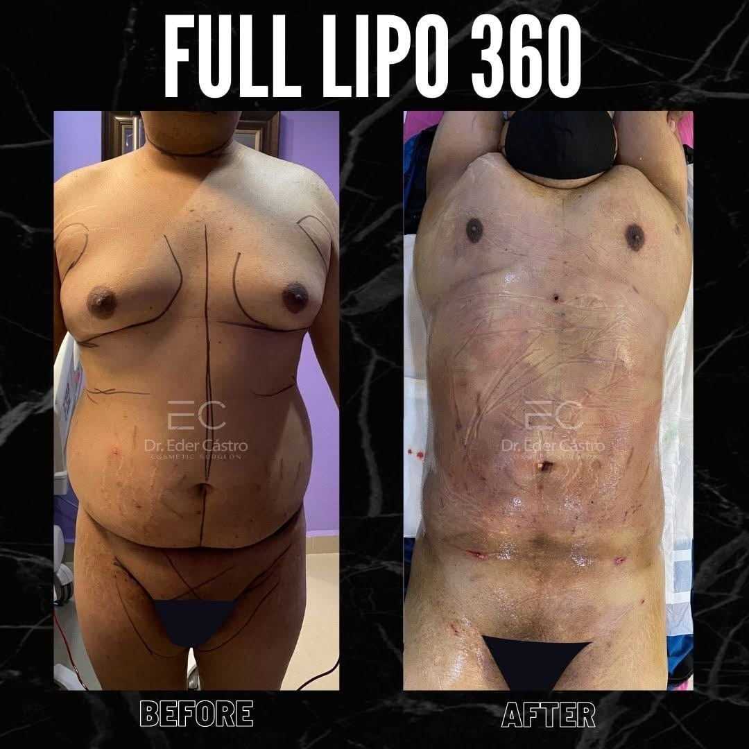 Liposuction (Lipo 360)  KWU's Health & Wellness Spa LLC