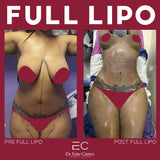 Liposuction (Lipo 360)