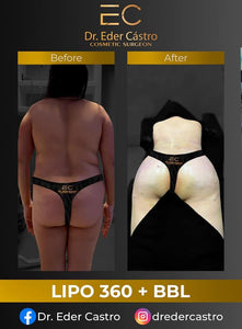 Brazilian Butt Lift (deposit only)