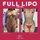 Liposuction (Lipo 360)