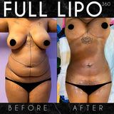 Liposuction (Lipo 360)