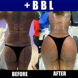 Brazilian Butt Lift (deposit only)