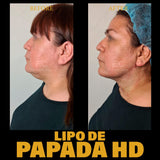 Chin Lipo (Lipo Papada) (deposit only)