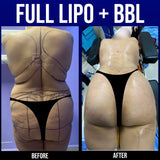 Brazilian Butt Lift (deposit only)