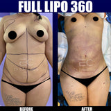 Liposuction (Lipo 360)