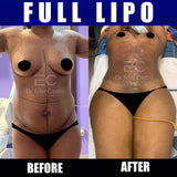 Liposuction (Lipo 360)