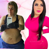 Chin Lipo (Lipo Papada) (deposit only)